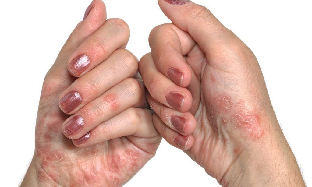 vảy nến ở tay