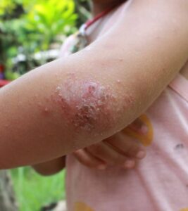 vảy nến ở trẻ em