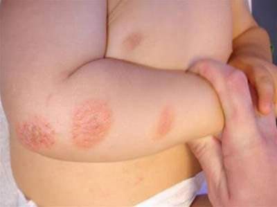 vảy nến ở trẻ em - Image 3