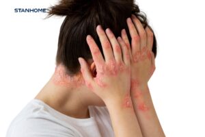 vảy nến tái phát