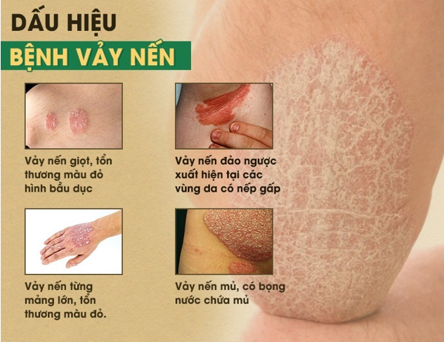 vảy nến tái phát - Image 4