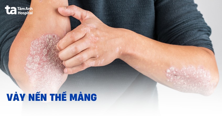 vảy nến thể mảng - Image 3