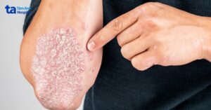vảy nến thể mảng