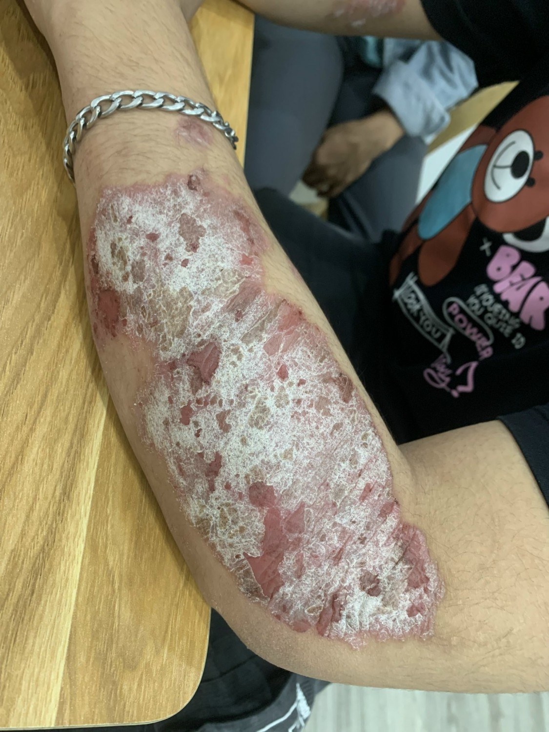 vảy nến thể nặng - Image 3