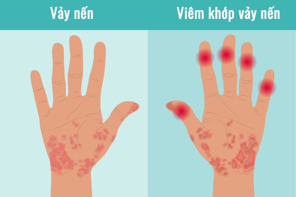 vảy nến và viêm khớp