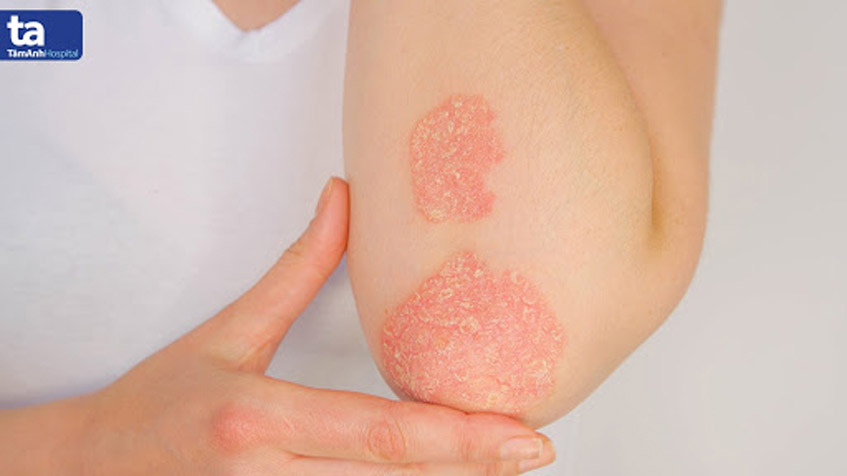 vảy nến và viêm khớp - Image 3