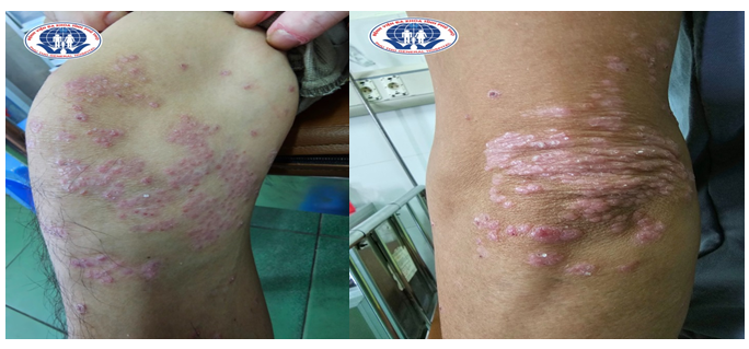 vảy nến và viêm khớp - Image 5