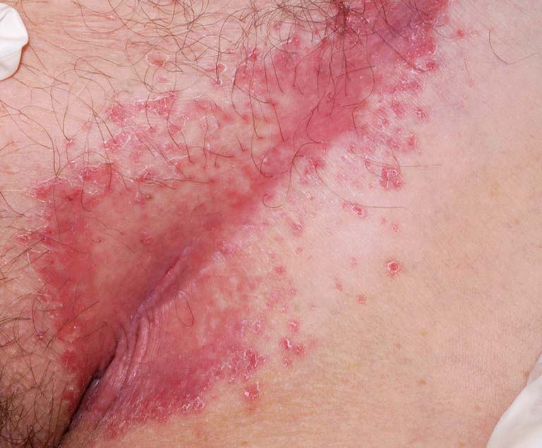 vảy nến vùng sinh dục - Image 3