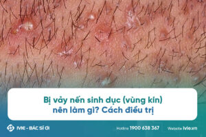 vảy nến vùng sinh dục