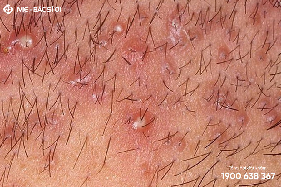 vảy nến vùng sinh dục - Image 4