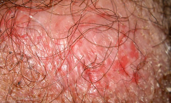vảy nến vùng sinh dục - Image 5