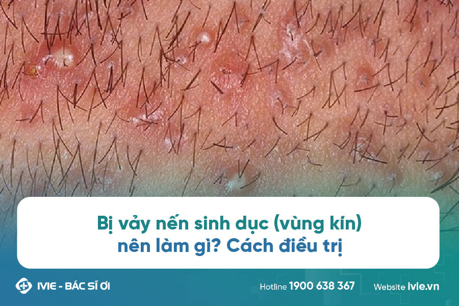 vảy nến vùng sinh dục