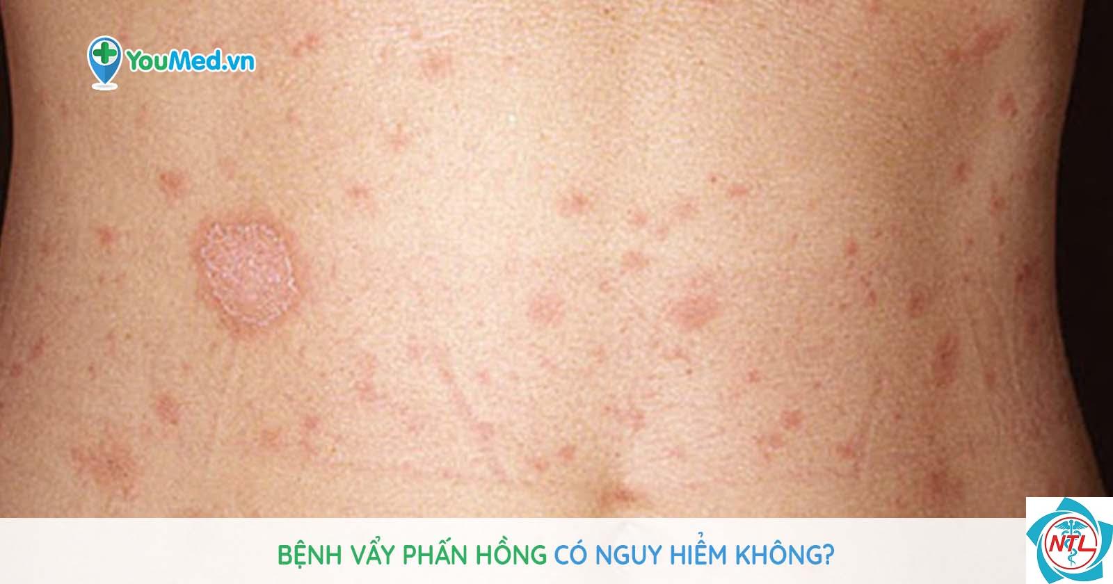 vảy phấn hồng ở phụ nữ mang thai - Image 3