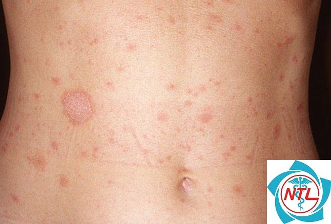 vảy phấn hồng ở phụ nữ mang thai