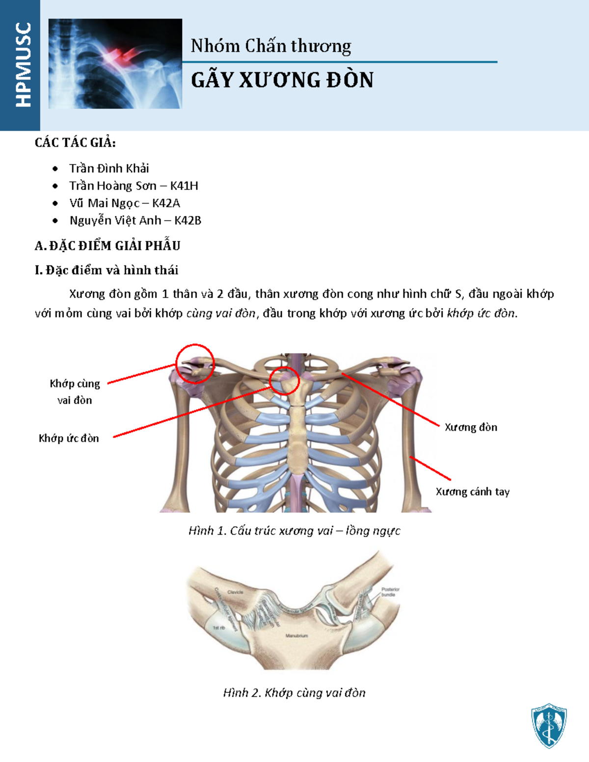 vị trí gãy xương đòn thường gặp - Image 5