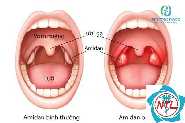 viêm amidan mạn tính - Image 3