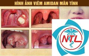 viêm amidan mạn tính