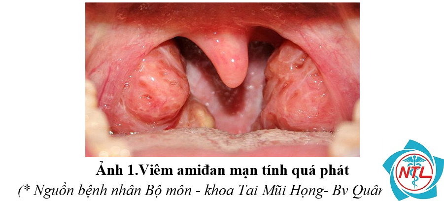 viêm amidan mạn tính - Image 4