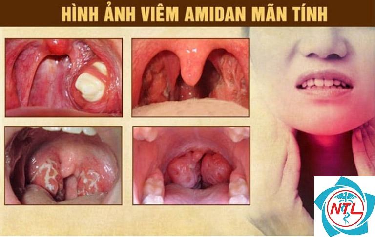 viêm amidan mạn tính - Image 1