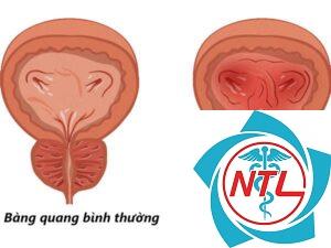 viêm bàng quang