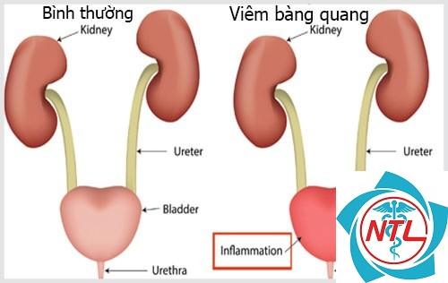 viêm bàng quang - Image 5