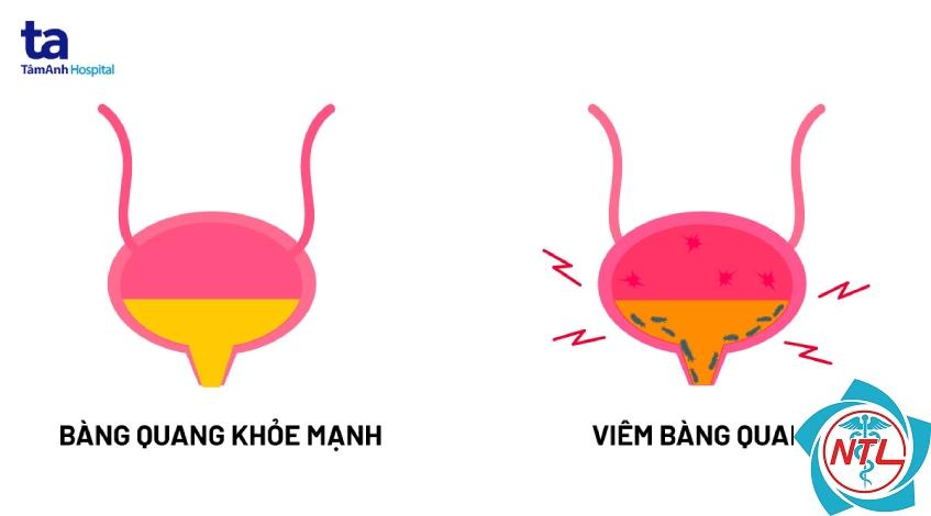 viêm bàng quang cấp - Image 2
