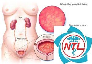 viêm bàng quang cấp