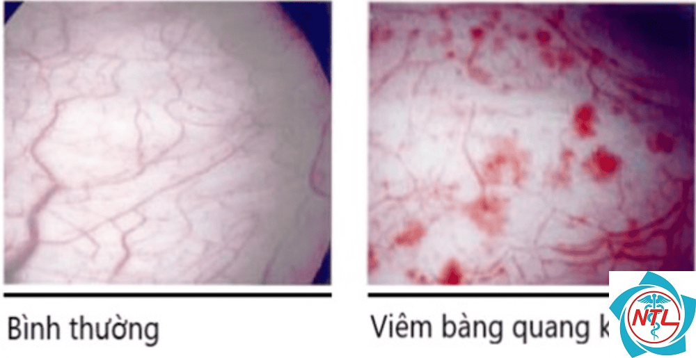 viêm bàng quang kẽ - Image 2