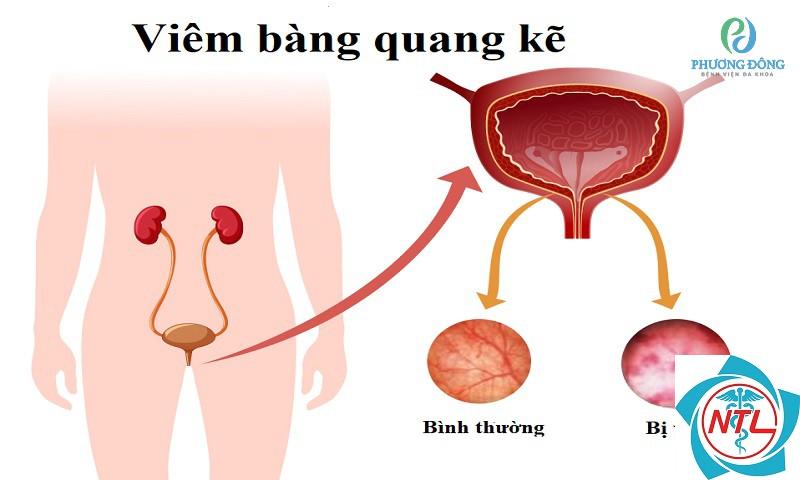 viêm bàng quang kẽ - Image 4