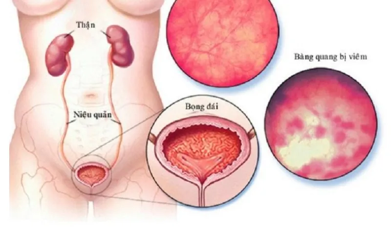 viêm bàng quang kẽ