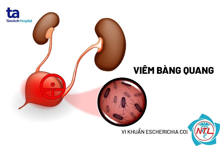 viêm bàng quang mạn - Image 2