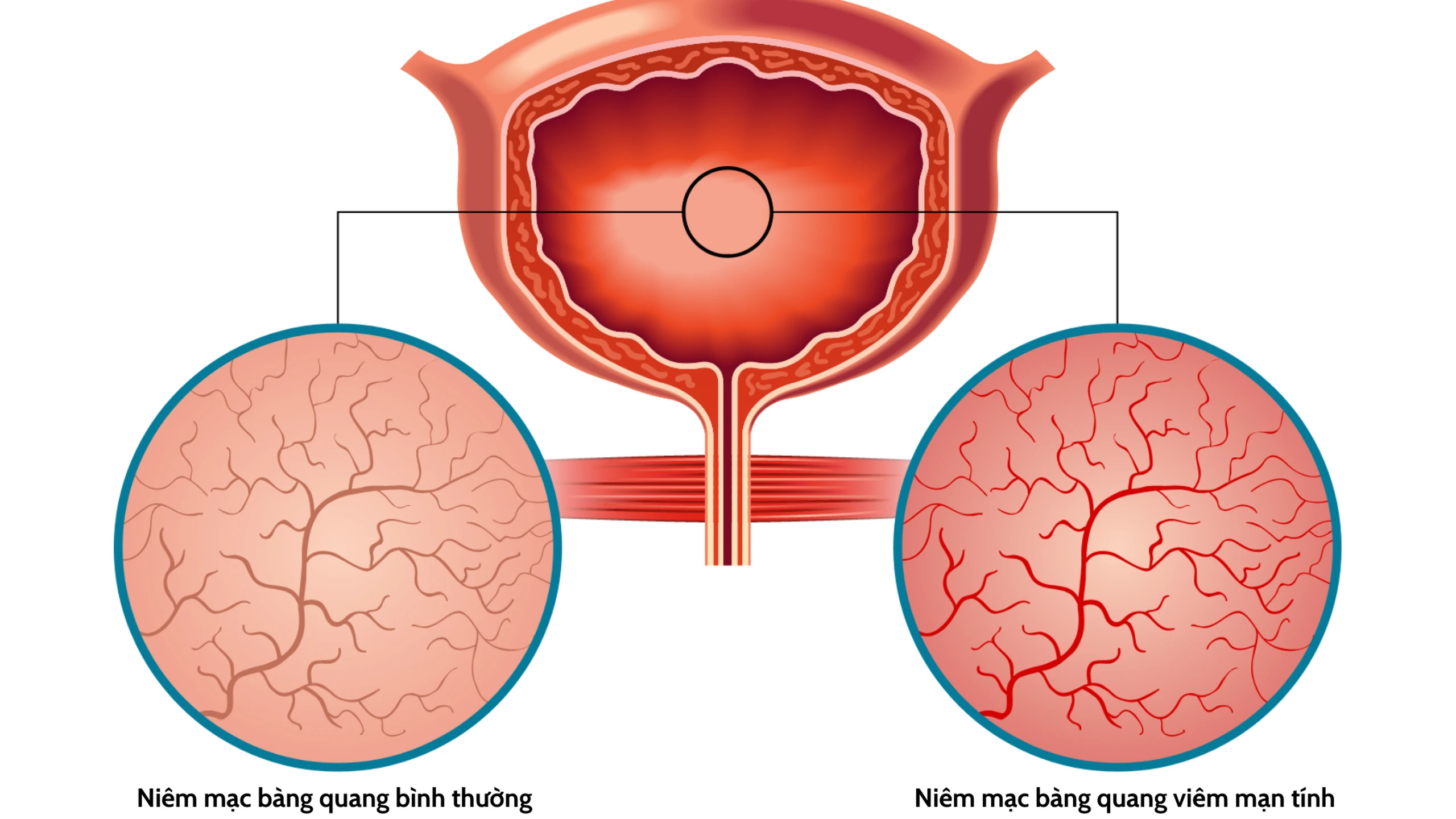 viêm bàng quang mạn - Image 3