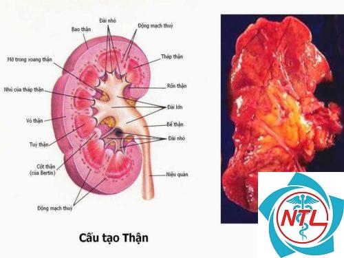 viêm bể thận - Image 5