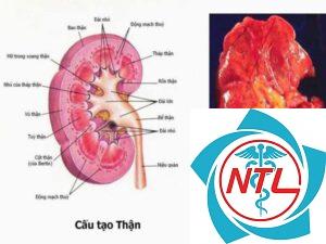 viêm bể thận cấp