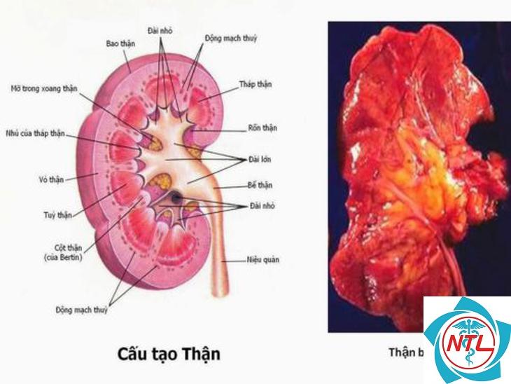 viêm bể thận mạn - Image 2