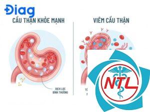 viêm cầu thận