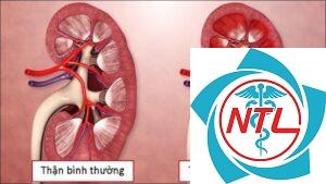 viêm cầu thận cấp