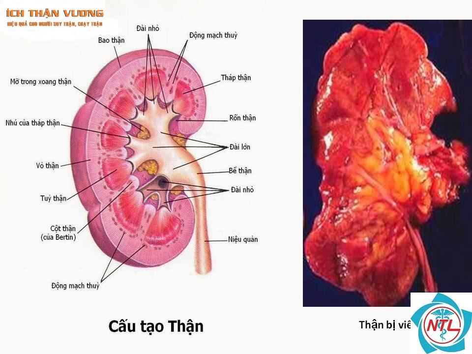viêm cầu thận cấp - Image 5