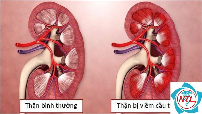 viêm cầu thận cấp