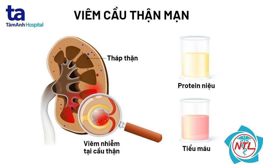 viêm cầu thận mạn