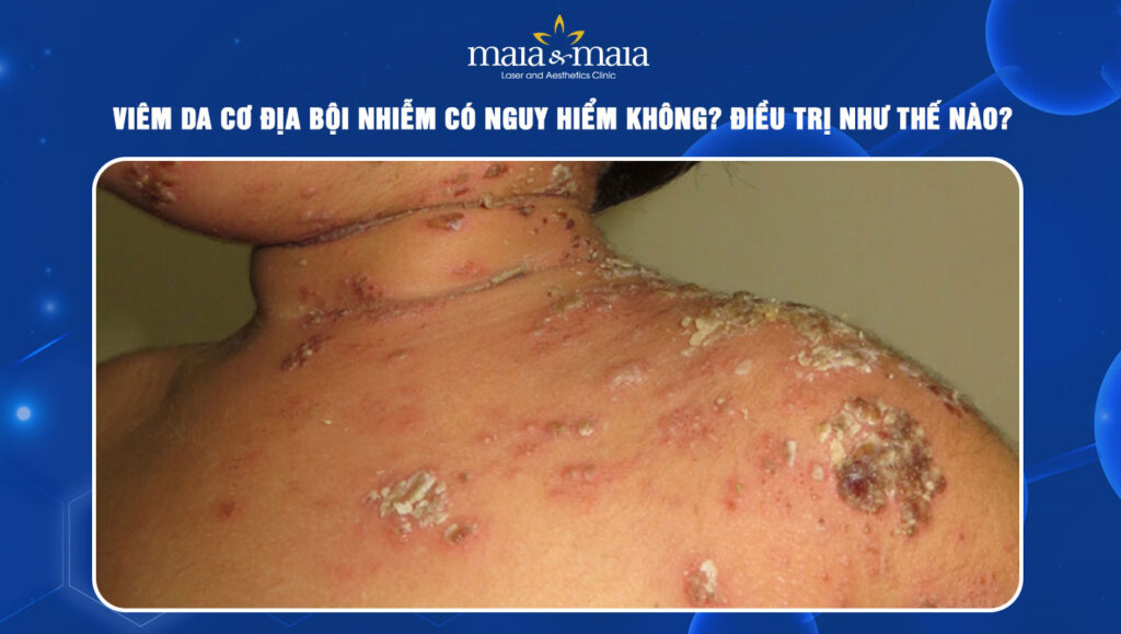viêm da bội nhiễm