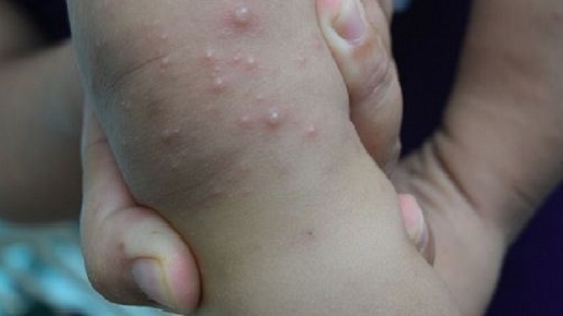 viêm da bóng nước o tre em - Image 3
