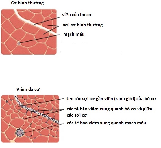 viêm đa cơ - Image 5