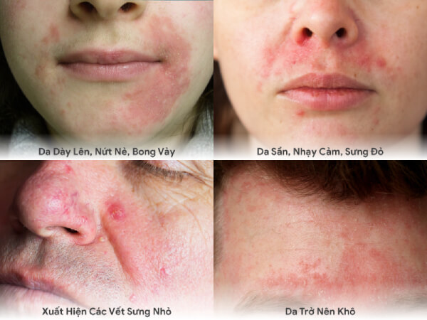 viêm da cơ địa do thời tiết - Image 2