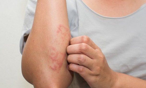 viêm da cơ địa mãn tính - Image 2
