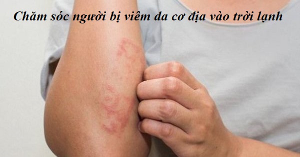 viêm da cơ địa mùa đông - Image 2