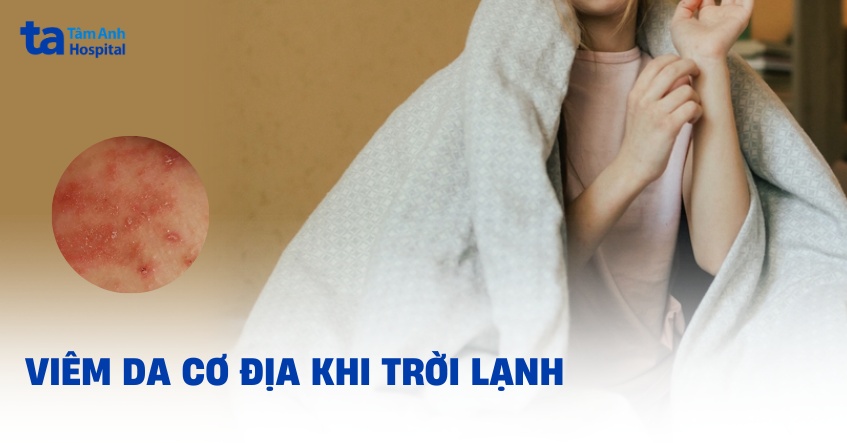 viêm da cơ địa mùa đông - Image 3
