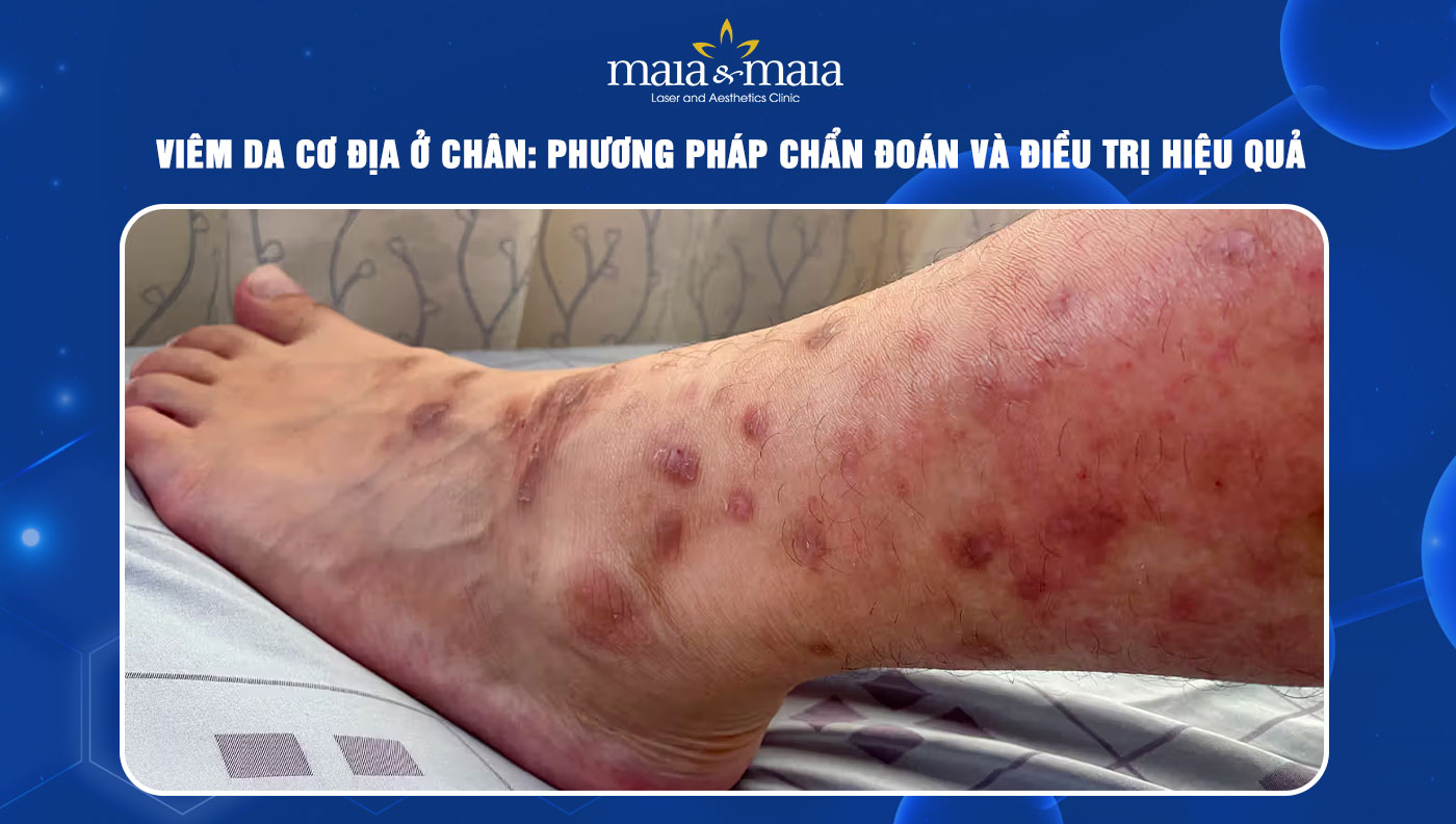 viêm da cơ địa ở chân - Image 2
