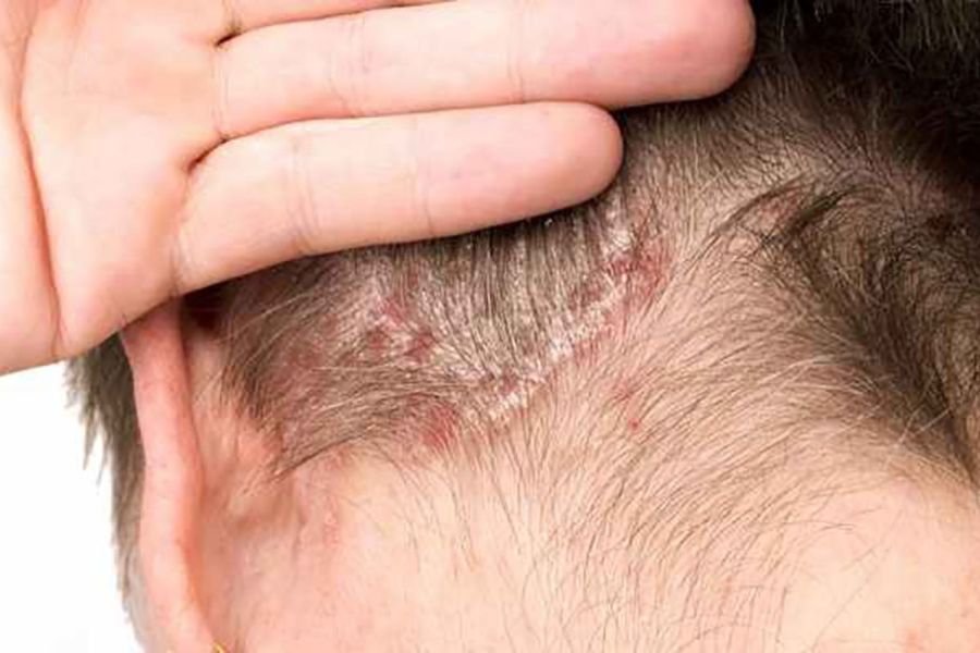 viêm da cơ địa ở đầu