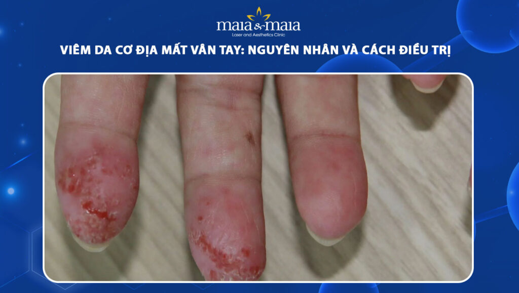 viêm da cơ địa ở ngón tay